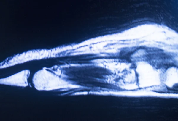 МРТ магнітно-резонансна томографія ручного сканування — стокове фото