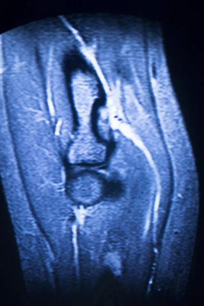 МРТ магнітно-резонансна томографія сканування ліктьової руки — стокове фото