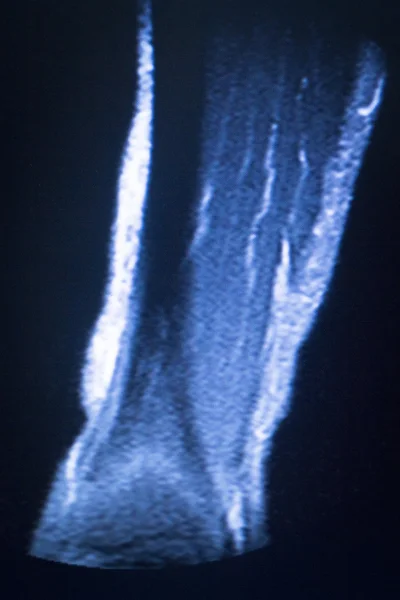 Mri 磁共振成像医学扫描 — 图库照片