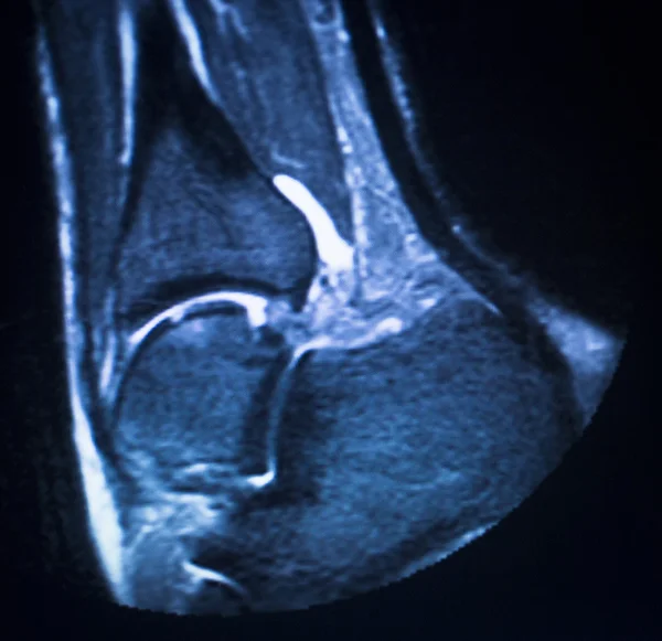 MRI magnetic resonance imaging ankle scan — Stock Photo, Image