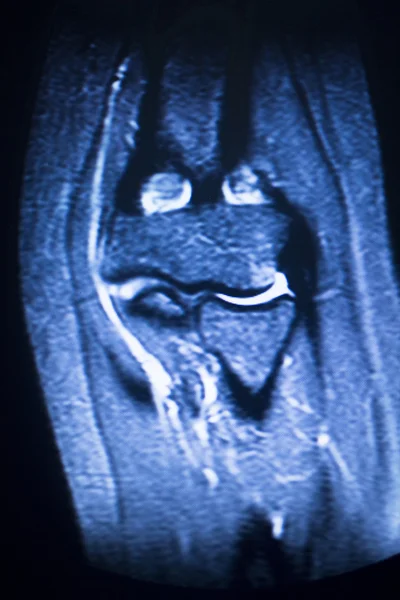 MRI magnetic resonance imaging elbow arm scan — Stock Photo, Image
