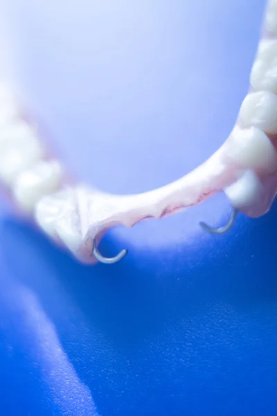 Removable partial dentures — Stock Photo, Image