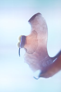 Çıkarılabilir Kısmi Protez