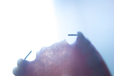 Çıkarılabilir Kısmi Protez