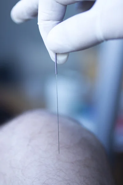 건조 한 needling 침술 바늘 — 스톡 사진