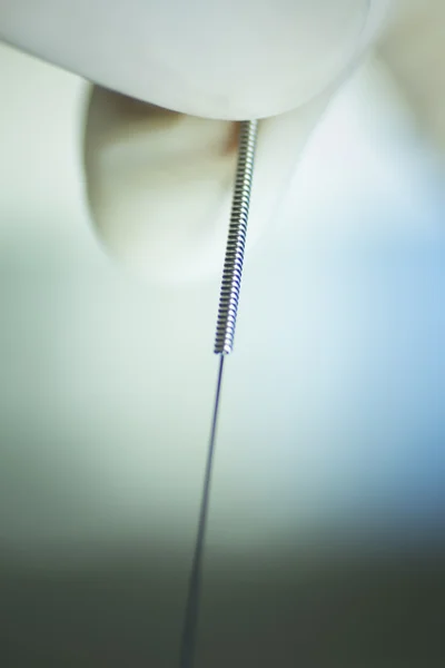 Akupunktúrás tű száraz needling — Stock Fotó