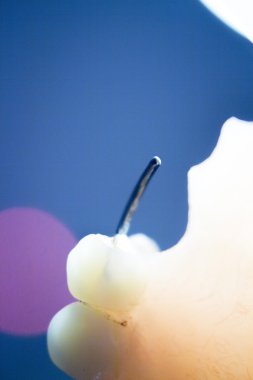 Protez diş Kısmi Protez