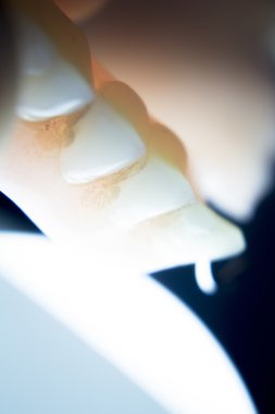 Protez diş Kısmi Protez