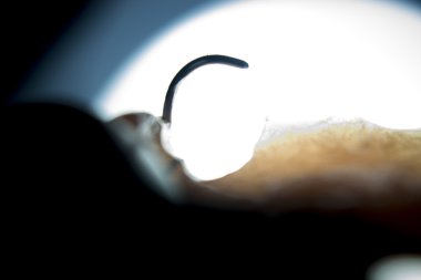 Protez diş Kısmi Protez