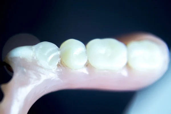 Prótesis dentales parciales dentales — Foto de Stock