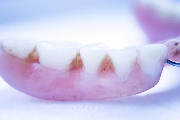 Prosthetic dental partial dentures — Stock Photo, Image