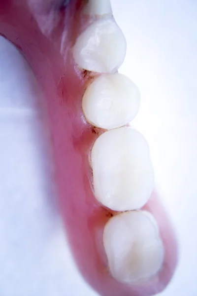 Protez diş Kısmi Protez — Stok fotoğraf