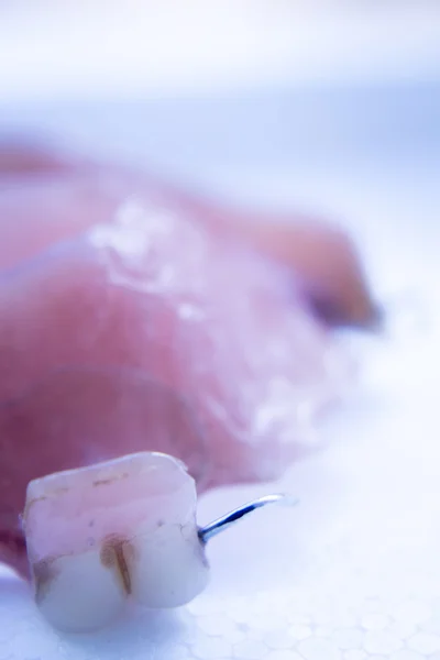 Prosthetic dental partial dentures — Stock Photo, Image