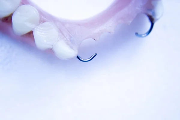 Protezy stomatologiczne protezy częściowe — Zdjęcie stockowe
