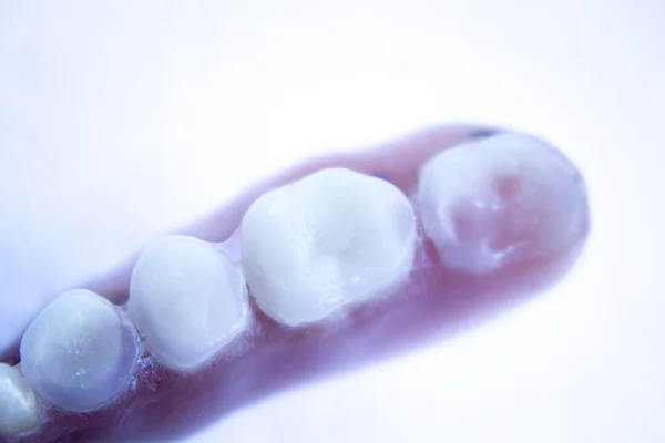 Prótesis dentales parciales dentales —  Fotos de Stock
