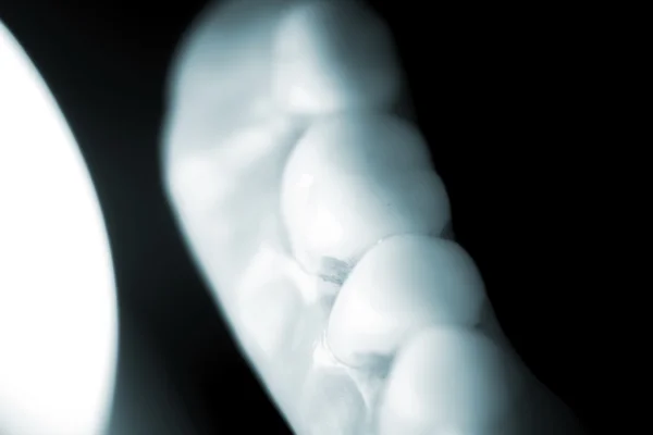Προσθετική οδοντιατρική μερικές οδοντοστοιχίες — Φωτογραφία Αρχείου