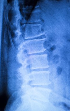 Kneck ve omurga yaralanması x-ray tarama