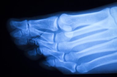 Ayak ve ayak parmakları yaralanma x-ray tarama