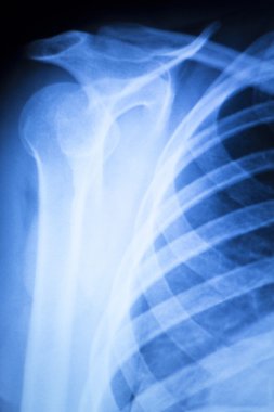 Omuz yaralanması ortopedi xray tarama
