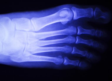 Ayak ve ayak parmakları yaralanma x-ray tarama