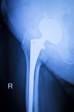 Kalça titanyum implant yerine xray