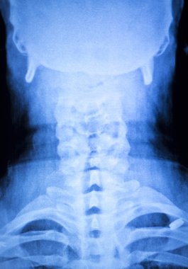 Kneck ve omurga yaralanması x-ray tarama
