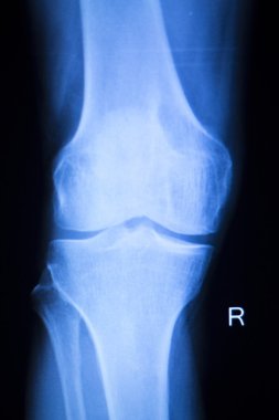 Diz eklem Menisküs x-ray sınama taraması