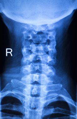 Kneck ve omurga yaralanması x-ray tarama