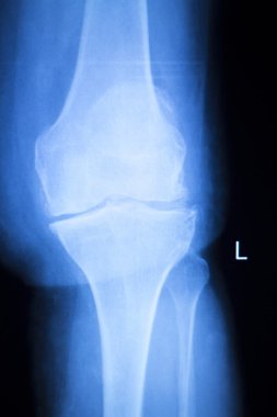 Diz eklem Menisküs x-ray sınama taraması