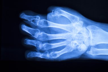 El parmak başparmak hastane xray inceden inceye gözden geçirmek