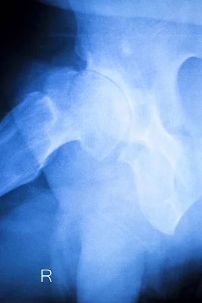 Výsledky kontroly artritidou kyčle xray — Stock fotografie