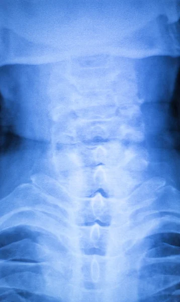 Kneck and spine injury x-ray scan — Stock Photo, Image