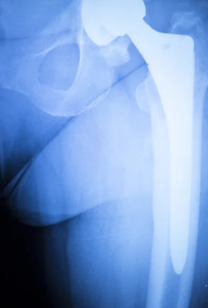 Hip titanium implant replacement xray — Stock Photo, Image