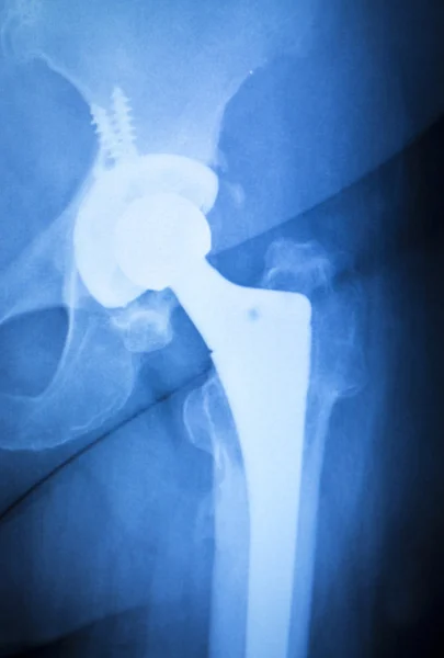 Hip titanové implantáty náhradní xray — Stock fotografie