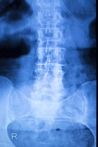 克内克和脊柱损伤的 x 线扫描 — 图库照片