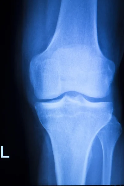 Рентгеновское сканирование коленного сустава мениска — стоковое фото