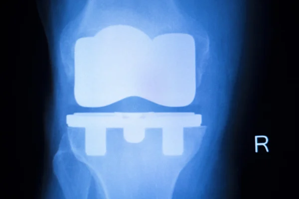 Examen radiographique de l'implant articulaire du genou — Photo