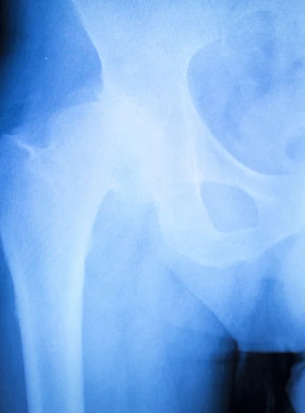 Résultats des tests de radiographie arthritique de la hanche — Photo
