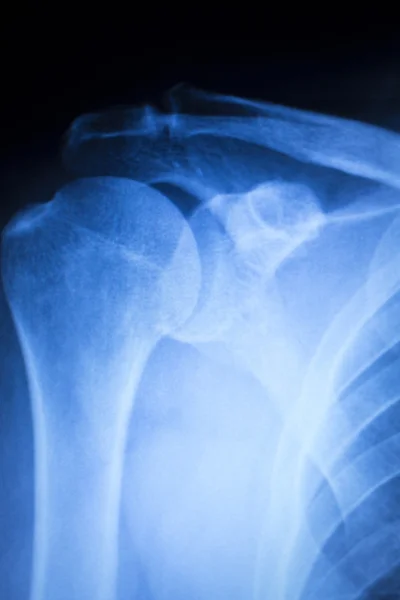 Травма плеча ортопедический рентген — стоковое фото