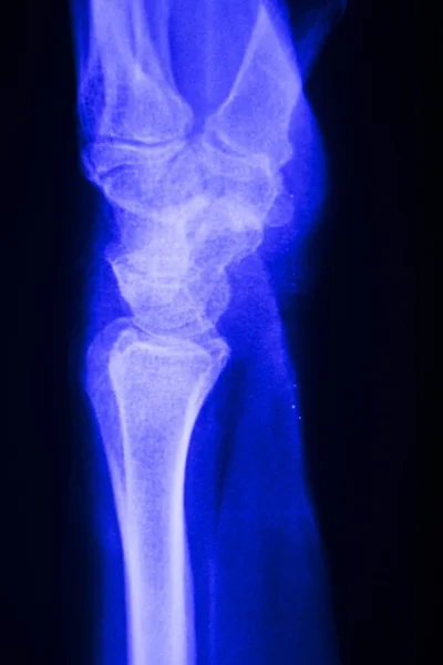 Diz eklem Menisküs x-ray sınama taraması — Stok fotoğraf