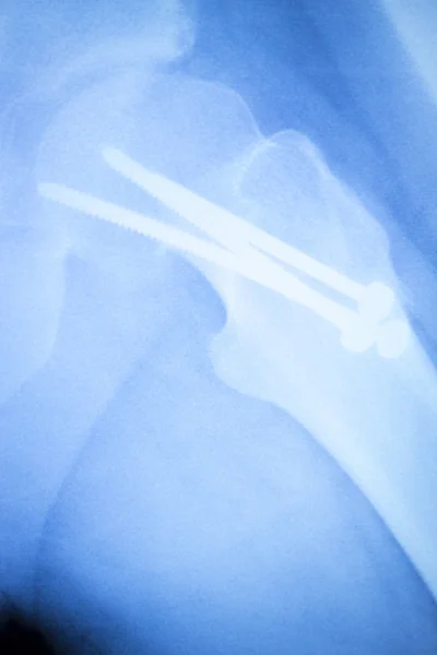 髋关节钛植入替代 x 射线 — 图库照片