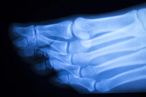 Pé e dedos dos pés lesão raio-X digitalização — Fotografia de Stock