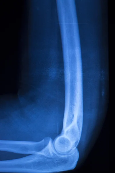 Exploración de rayos X del codo del brazo del implante quirúrgico — Foto de Stock