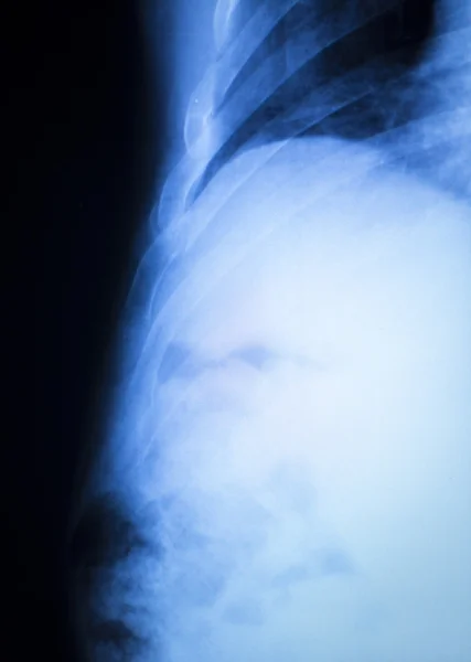 Травма плеча ортопедический рентген — стоковое фото
