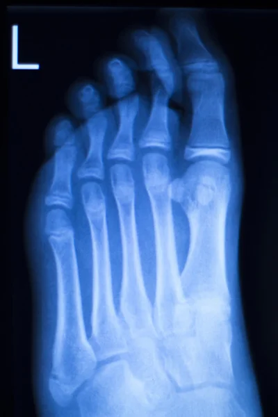 Πόδι και τα δάχτυλα των ποδιών τραυματισμό ακτινογραφία σάρωσης — Φωτογραφία Αρχείου