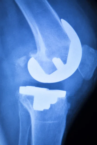 膝盖关节植入物的 x 射线测试扫描 — 图库照片