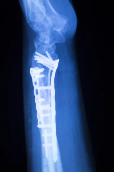 Hand orthopedics xray scan — Stock Photo, Image