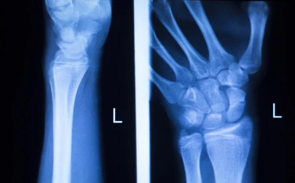 Mão dedo polegar varredura de raios X hospital — Fotografia de Stock
