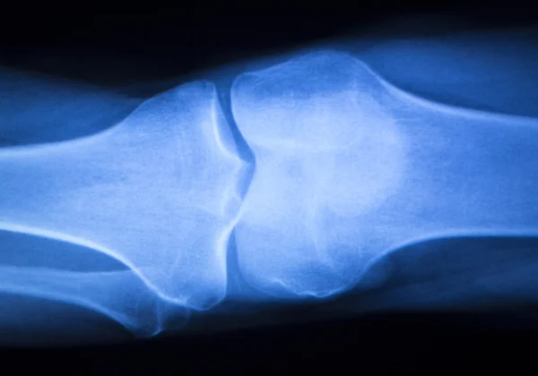 Knee joint meniscus x-ray test scan — Stock Photo, Image