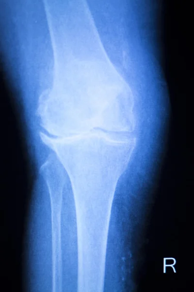 Examen de rayos X de menisco articular de rodilla — Foto de Stock